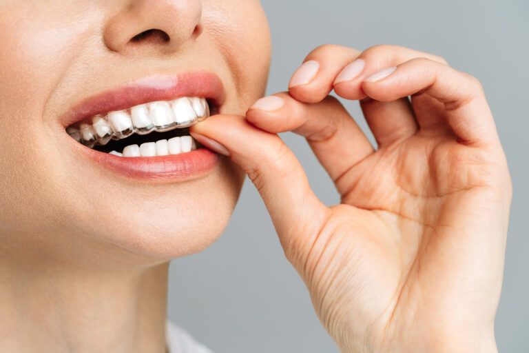 A young woman does a home teeth whitening procedure. Whitening tray with gel.